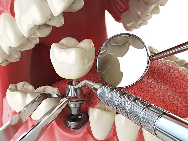 Best Emergency Tooth Extraction in Marion, VA