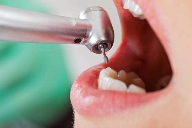Best Emergency Tooth Extraction in Marion, VA